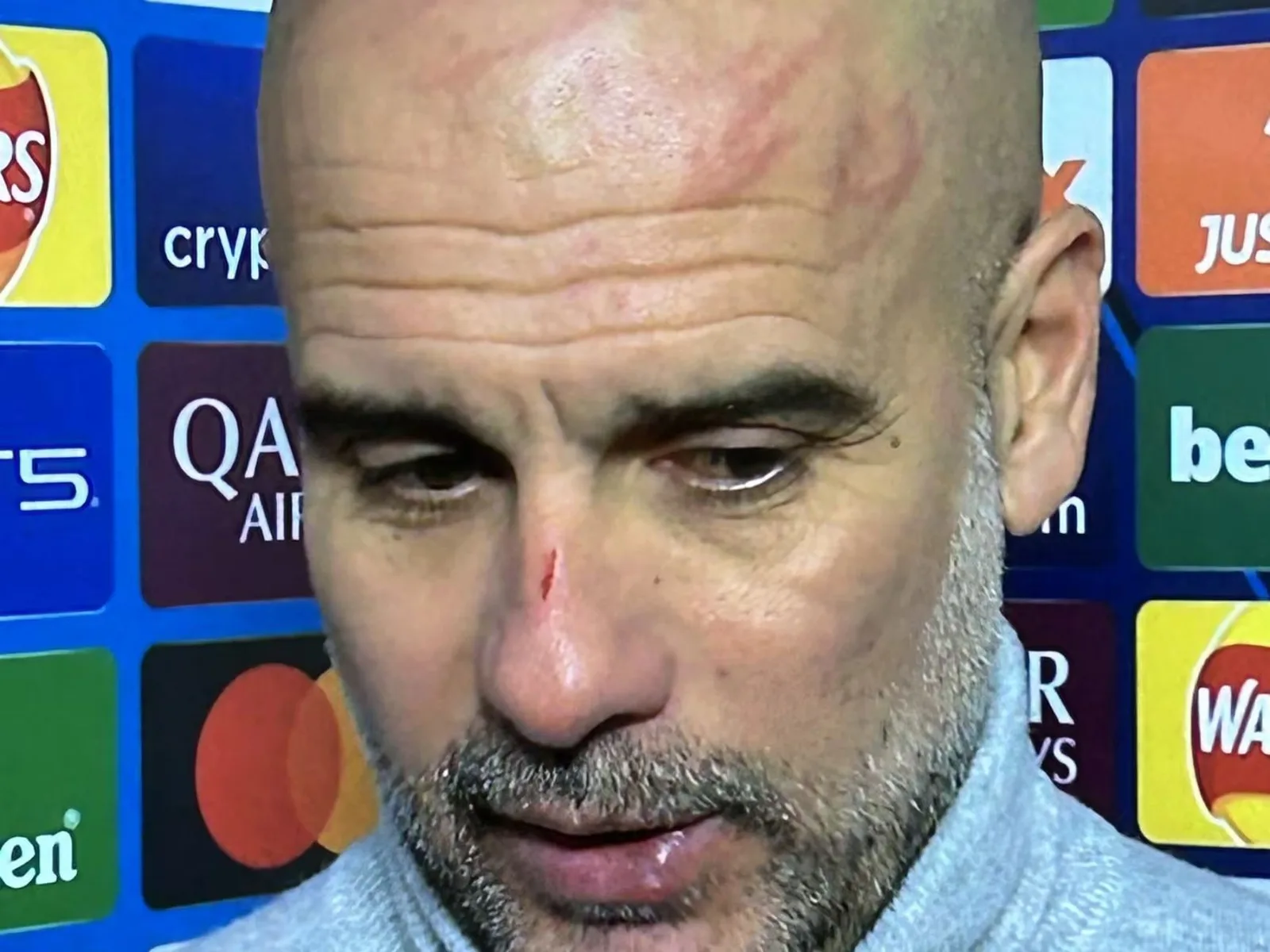 « Je voulais me faire du mal » – Pep Guardiola apparaît devant la presse avec des marques sur la tête